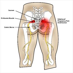 Piriformis Sciatic Nerve Block - Herniated Disc And Sciatica Pain - What Is The Connection?