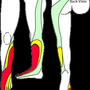 Sciatica In Both Legs - Sciatica... 3 Reasons Why You Still Have It