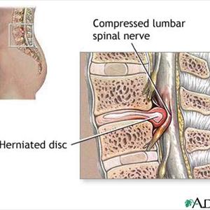 Sciatic Nerve Neuropathy Information - Pinched Nerve Pain Causes And Relief With The Drx9000 Spinal Decompression System