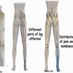 Back Sciatica Experts - Sciatica Stretches And Information