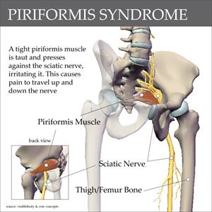 Sciatic Nerve Neuropathy Videos - Information On Sciatica