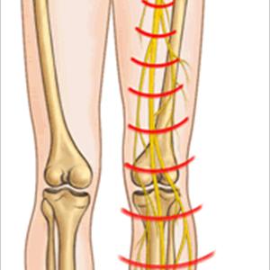 Pseudo Sciatica Treatment - All About Sciatica