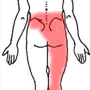 Sciatic Pain Treatment - Chiropractor, Tampa: Low Back Pain And Sciatica.