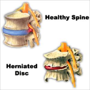 Sciatica Muscle Twitching - Sciatica Symptoms