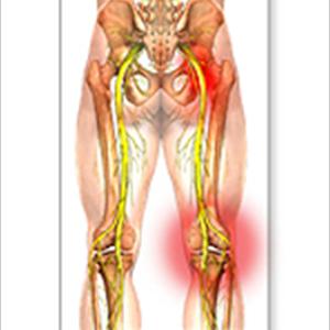 Back Sciatica Photos - How Sciataca Exercises Can Help Relief Pain