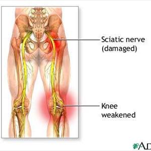 Healing Sciatica Pain - Cures For Sciatica - Causes Of Sciatica Nerve Pain